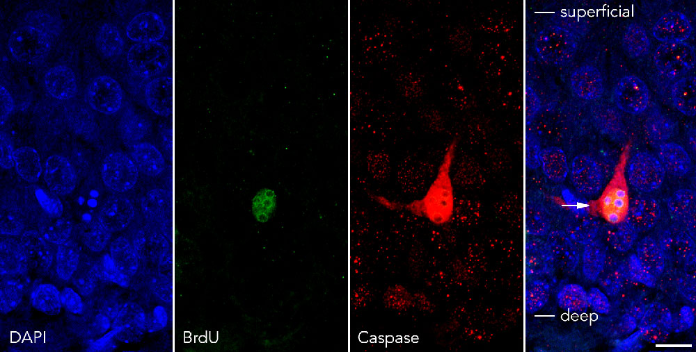Pyknotic caspase3+ neuron that was born in postnatal day 6